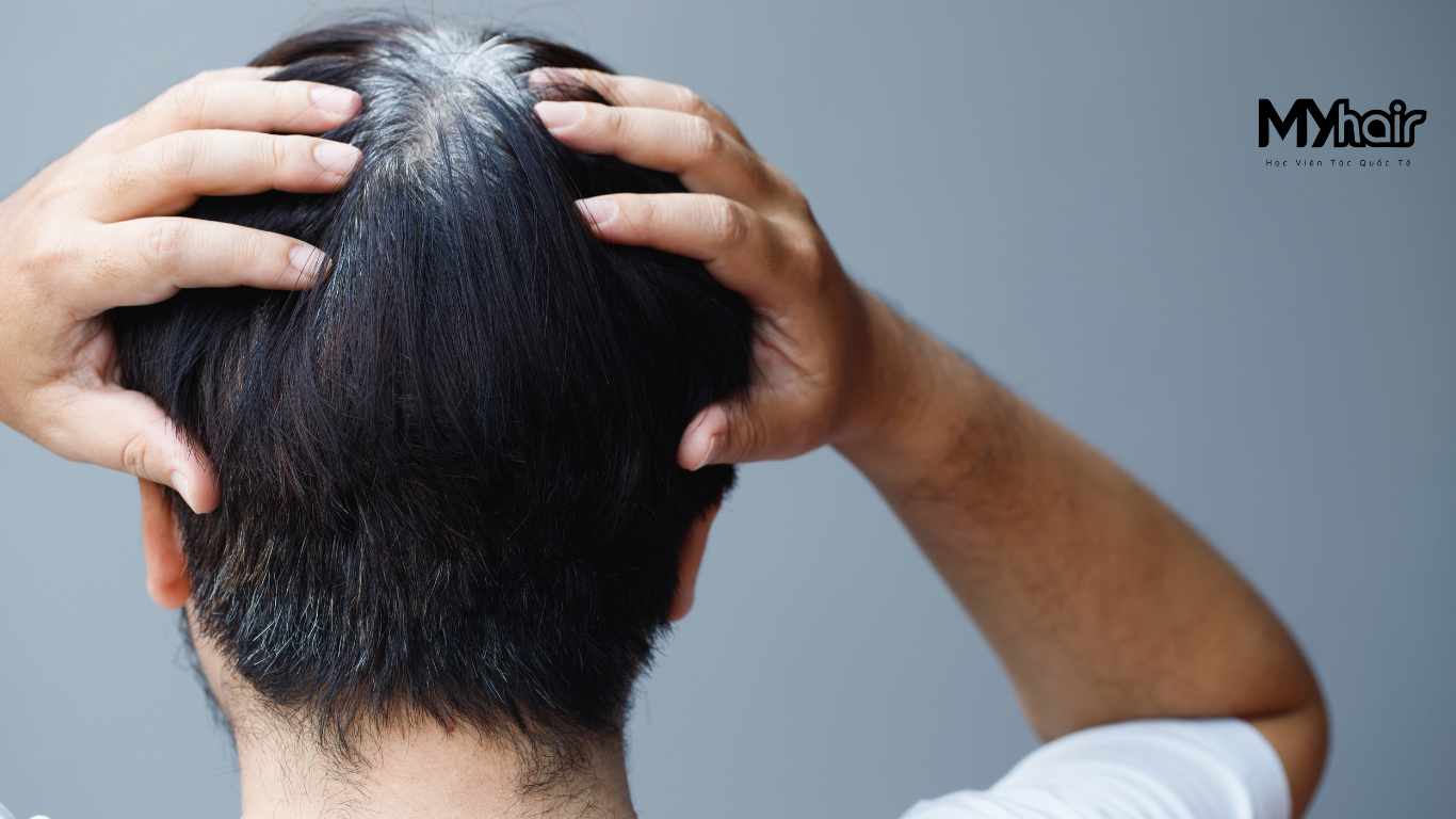 Nguyên nhân gây tóc bạc sớm